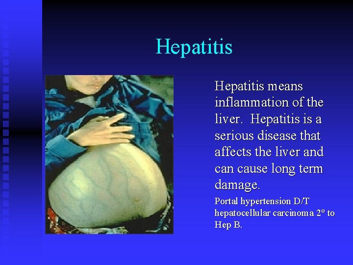 Hepatitis means inflammation of the liver. Hepatitis is a serious disease that affects the