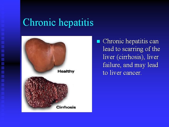 Chronic hepatitis n Chronic hepatitis can lead to scarring of the liver (cirrhosis), liver