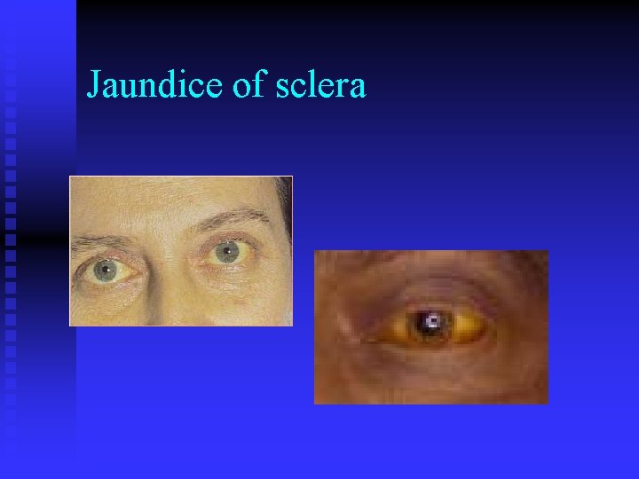 Jaundice of sclera 