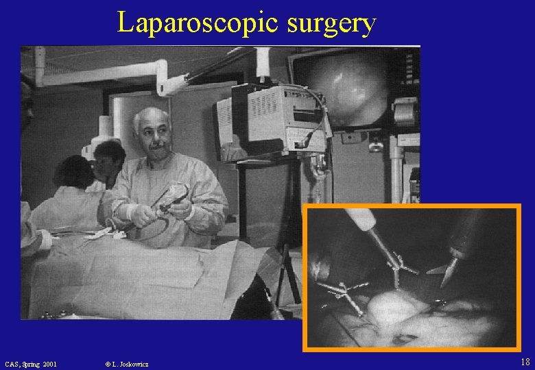 Laparoscopic surgery CAS, Spring 2001 © L. Joskowicz 18 