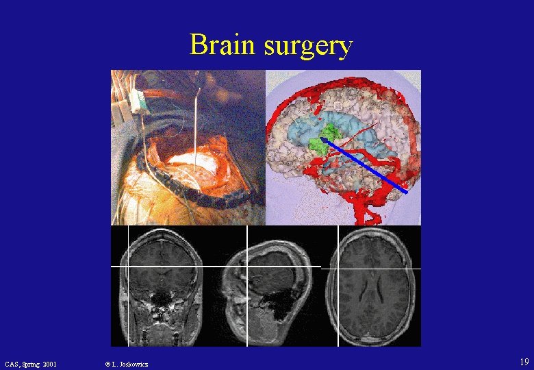 Brain surgery CAS, Spring 2001 © L. Joskowicz 19 