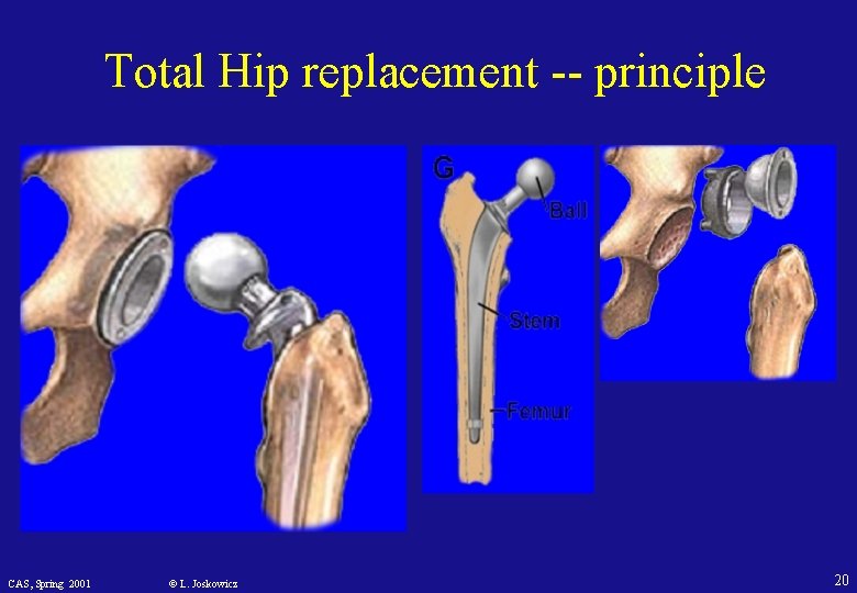 Total Hip replacement -- principle CAS, Spring 2001 © L. Joskowicz 20 