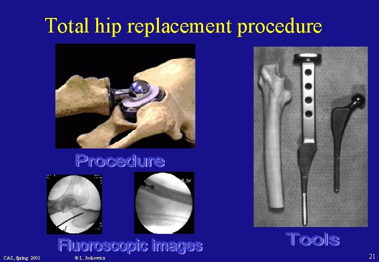 Total hip replacement procedure CAS, Spring 2001 © L. Joskowicz 21 