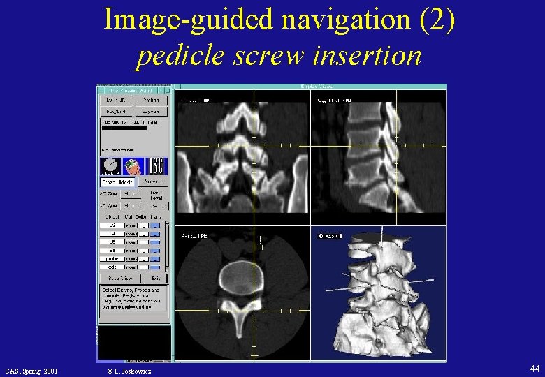 Image-guided navigation (2) pedicle screw insertion CAS, Spring 2001 © L. Joskowicz 44 