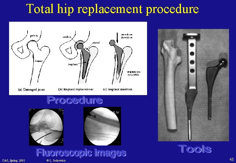 Total hip replacement procedure CAS, Spring 2001 © L. Joskowicz 48 