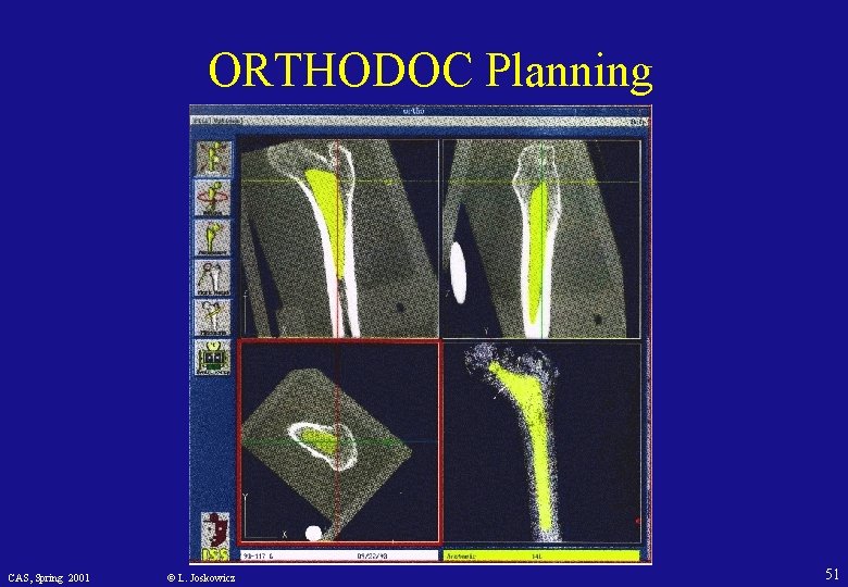 ORTHODOC Planning CAS, Spring 2001 © L. Joskowicz 51 