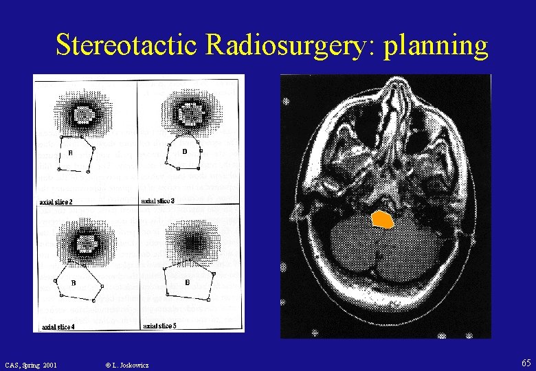 Stereotactic Radiosurgery: planning CAS, Spring 2001 © L. Joskowicz 65 