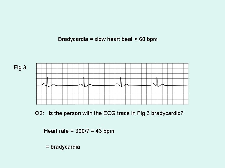 Bradycardia = slow heart beat < 60 bpm Fig 3 Q 2: is the