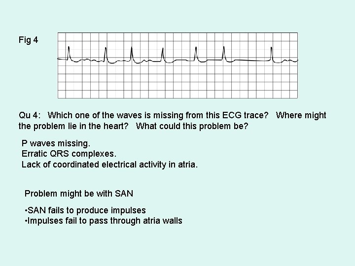Fig 4 Qu 4: Which one of the waves is missing from this ECG