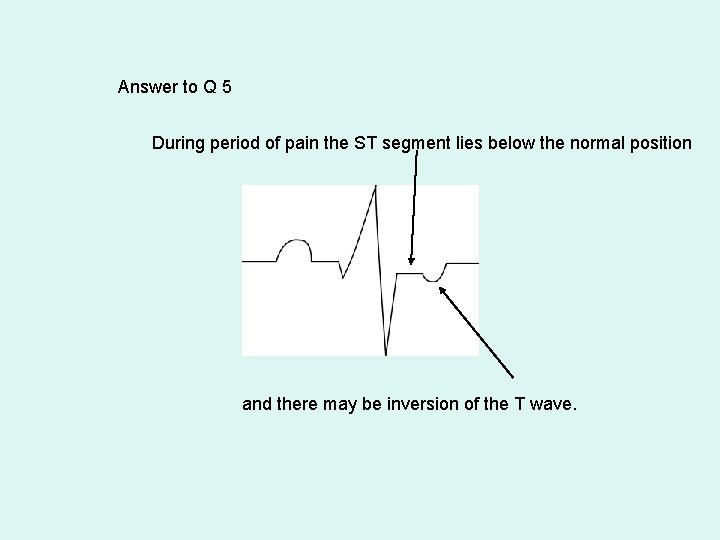Answer to Q 5 During period of pain the ST segment lies below the