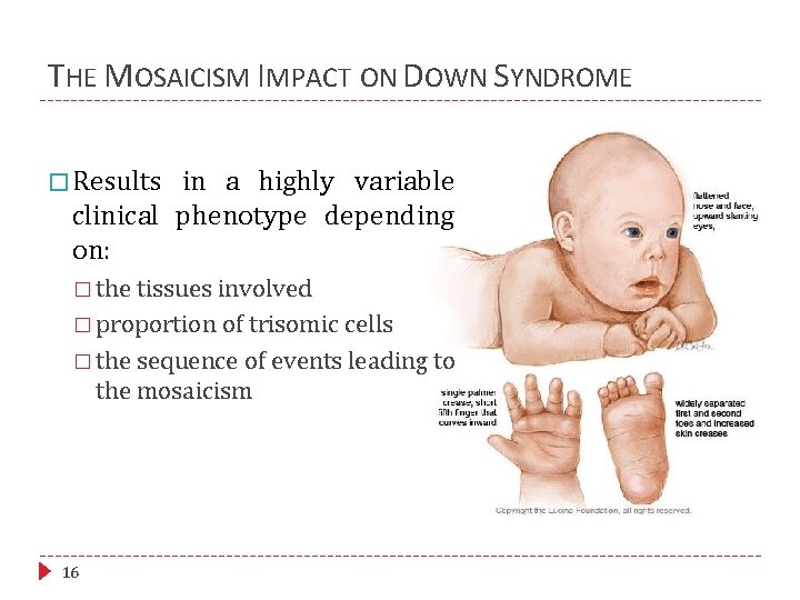 THE MOSAICISM IMPACT ON DOWN SYNDROME � Results in a highly variable clinical phenotype