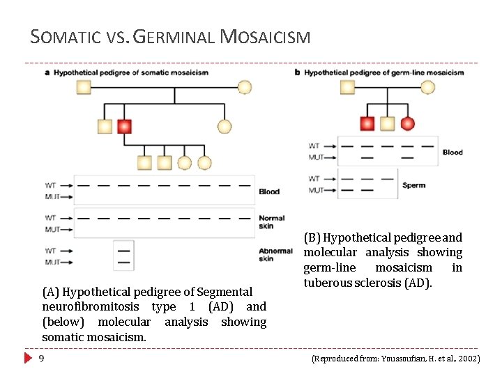 SOMATIC VS. GERMINAL MOSAICISM (A) Hypothetical pedigree of Segmental neurofibromitosis type 1 (AD) and