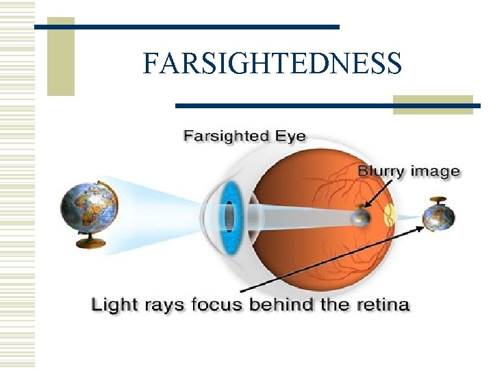 FARSIGHTEDNESS 