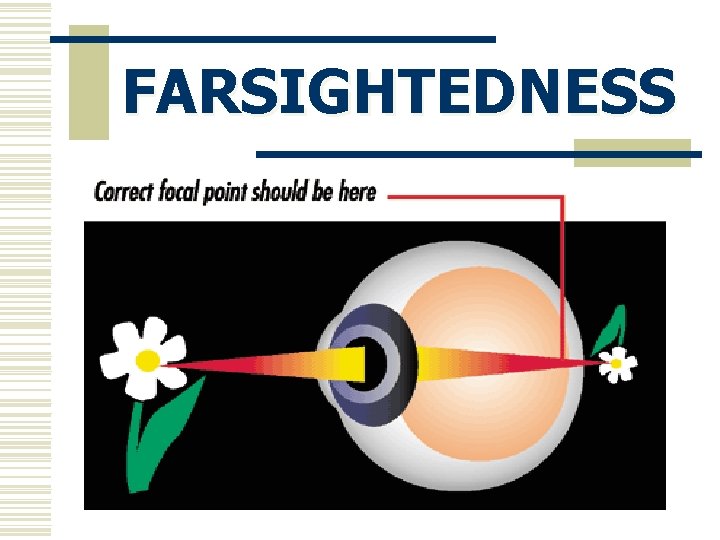 FARSIGHTEDNESS 
