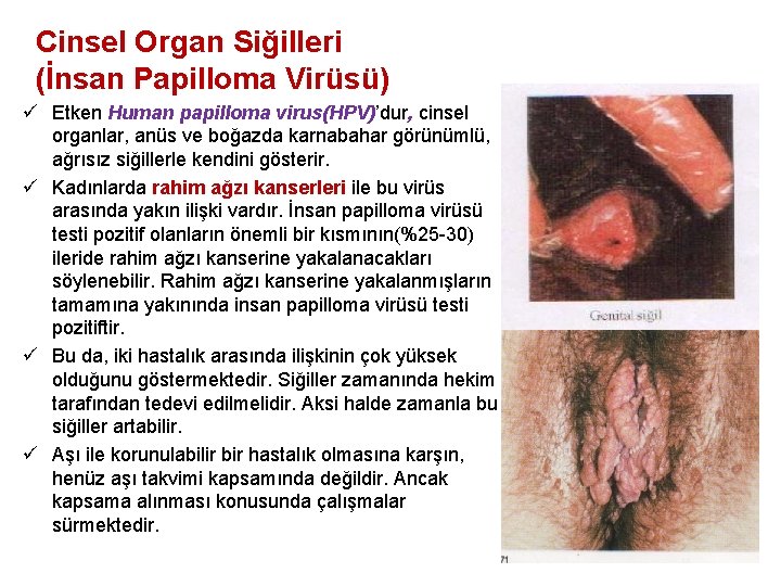 Cinsel Organ Siğilleri (İnsan Papilloma Virüsü) ü Etken Human papilloma virus(HPV)’dur, cinsel organlar, anüs