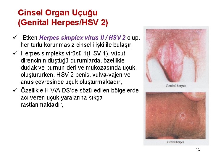 Cinsel Organ Uçuğu (Genital Herpes/HSV 2) ü Etken Herpes simplex virus II / HSV