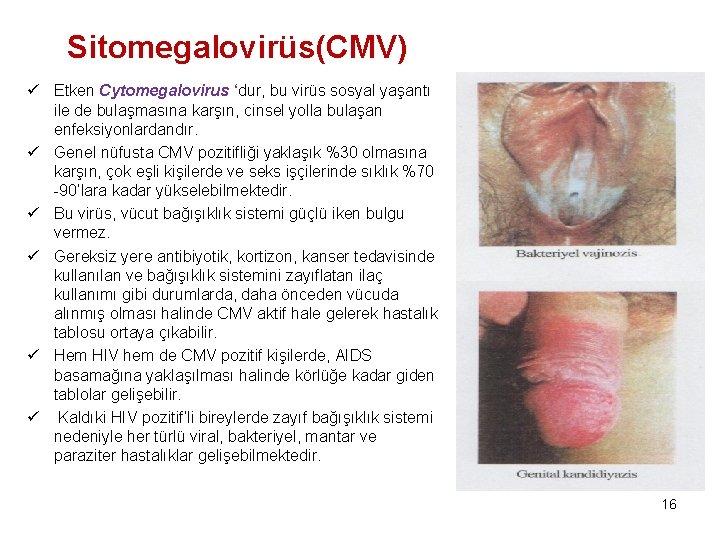 Sitomegalovirüs(CMV) ü Etken Cytomegalovirus ‘dur, bu virüs sosyal yaşantı ile de bulaşmasına karşın, cinsel