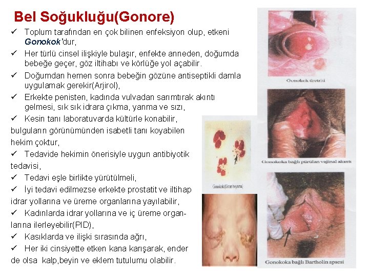 Bel Soğukluğu(Gonore) ü Toplum tarafından en çok bilinen enfeksiyon olup, etkeni Gonokok’dur, ü Her