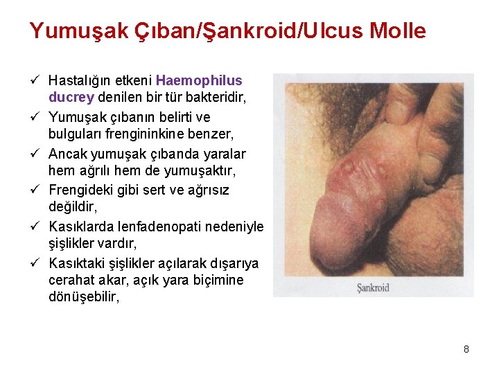 Yumuşak Çıban/Şankroid/Ulcus Molle ü Hastalığın etkeni Haemophilus ducrey denilen bir tür bakteridir, ü Yumuşak