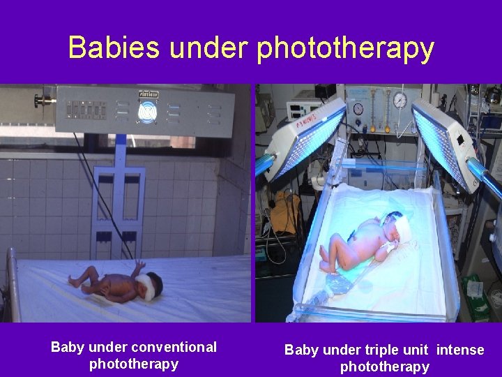 Babies under phototherapy Baby under conventional phototherapy Baby under triple unit intense phototherapy 