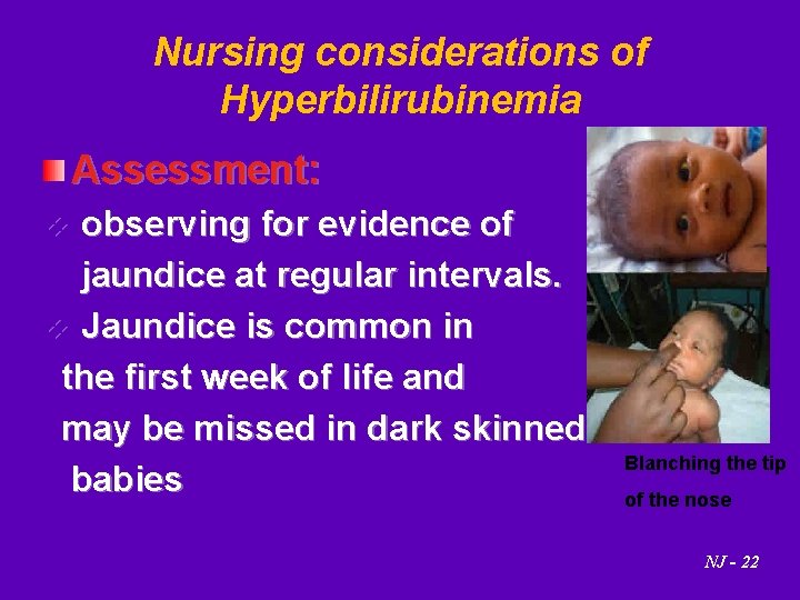 Nursing considerations of Hyperbilirubinemia Assessment: v observing for evidence of jaundice at regular intervals.