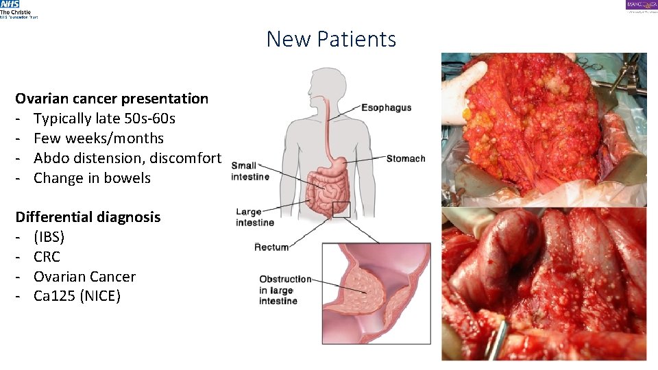 New Patients Ovarian cancer presentation - Typically late 50 s-60 s - Few weeks/months