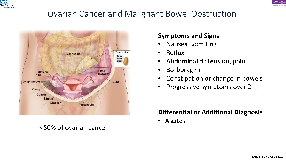 Ovarian Cancer and Malignant Bowel Obstruction Symptoms and Signs • Nausea, vomiting • Reflux