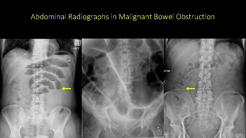 Abdominal Radiographs in Malignant Bowel Obstruction 