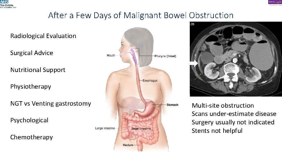 After a Few Days of Malignant Bowel Obstruction Radiological Evaluation Surgical Advice Nutritional Support