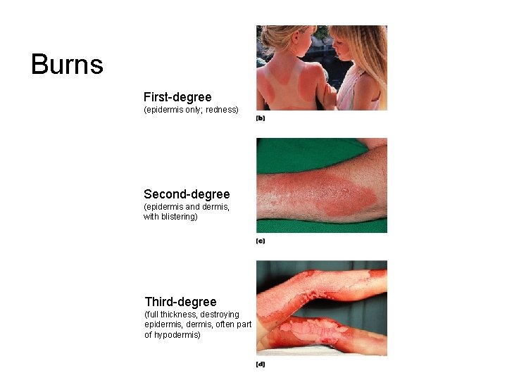 Burns First-degree (epidermis only; redness) Second-degree (epidermis and dermis, with blistering) Third-degree (full thickness,