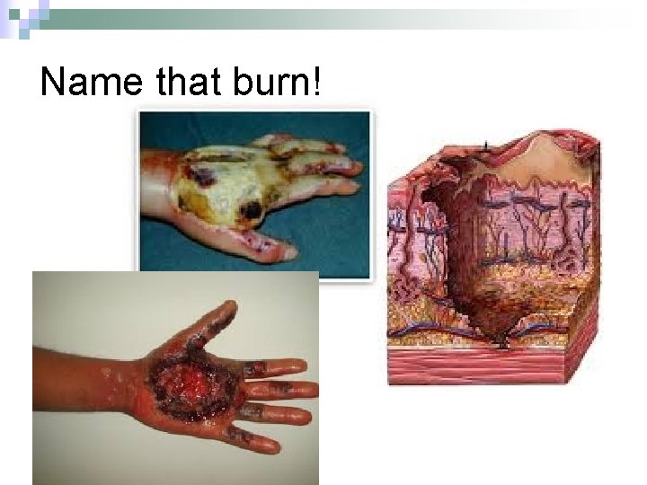 Name that burn! 