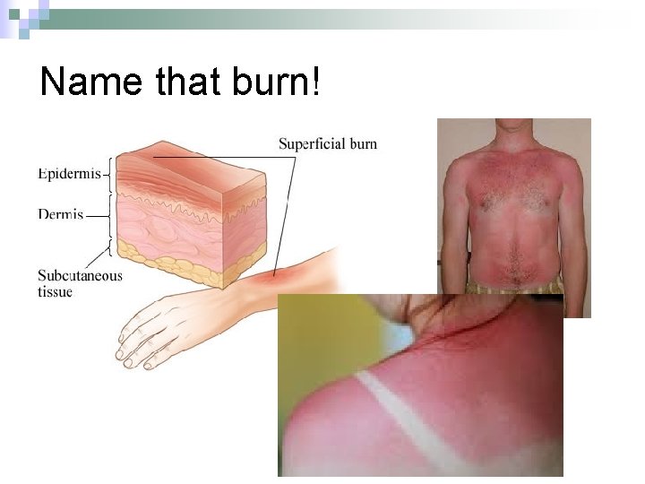 Name that burn! 