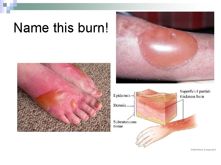 Name this burn! 
