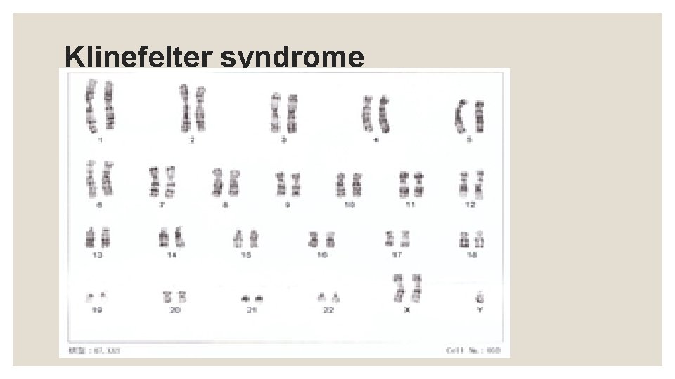 Klinefelter syndrome 