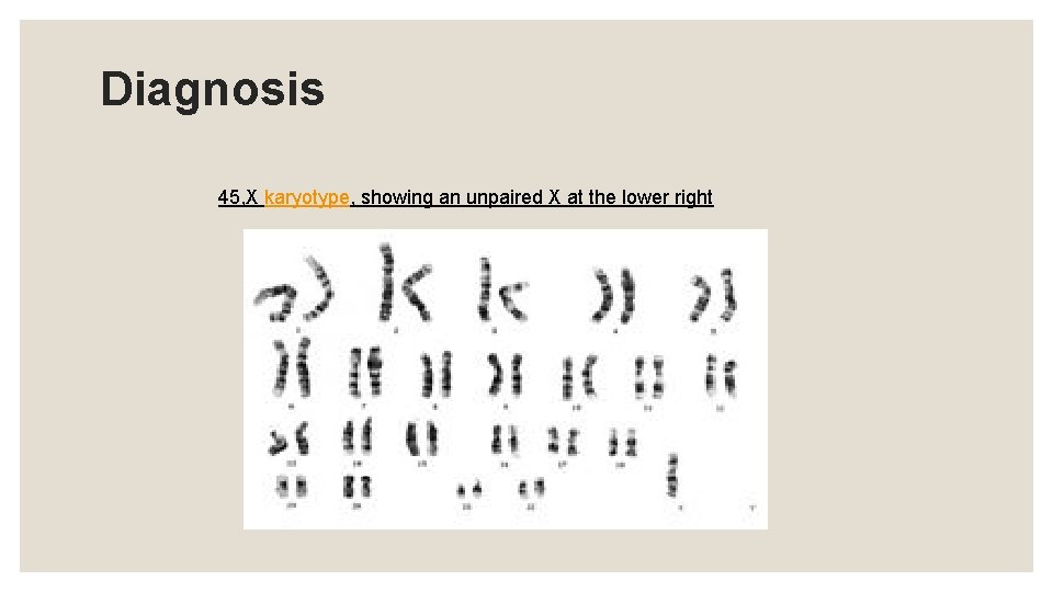 Diagnosis 45, X karyotype, showing an unpaired X at the lower right 