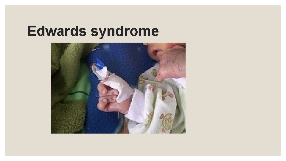 Edwards syndrome 