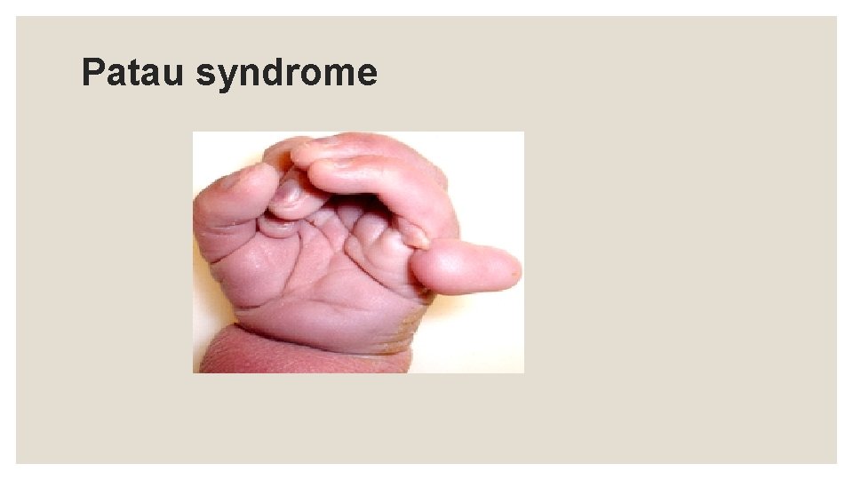 Patau syndrome 