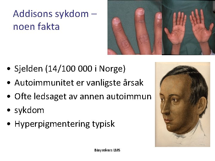 Addisons sykdom – noen fakta A • • • Sjelden (14/100 000 i Norge)