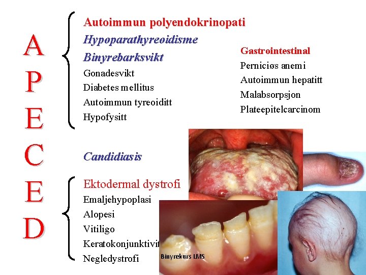 A P E C E D Autoimmun polyendokrinopati Hypoparathyreoidisme Gastrointestinal Binyrebarksvikt Gonadesvikt Diabetes mellitus