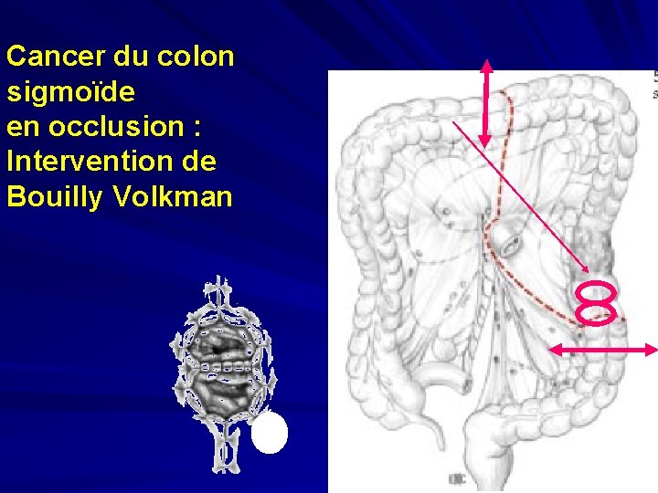 Cancer du colon sigmoïde en occlusion : Intervention de Bouilly Volkman 