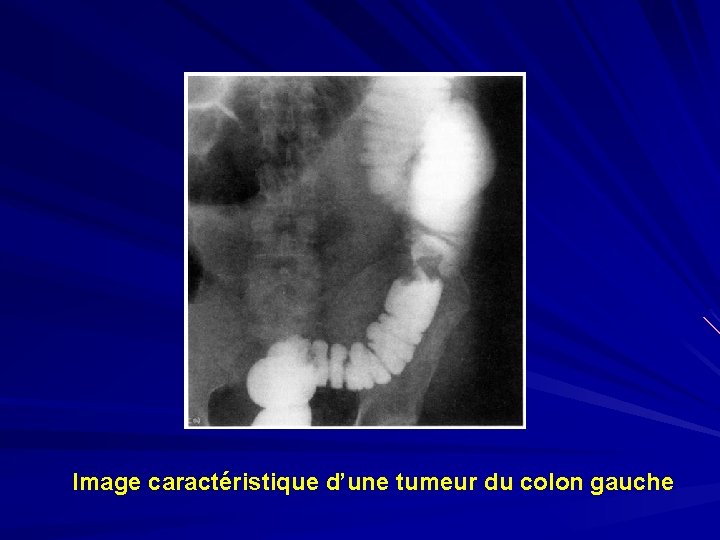 Image caractéristique d’une tumeur du colon gauche 