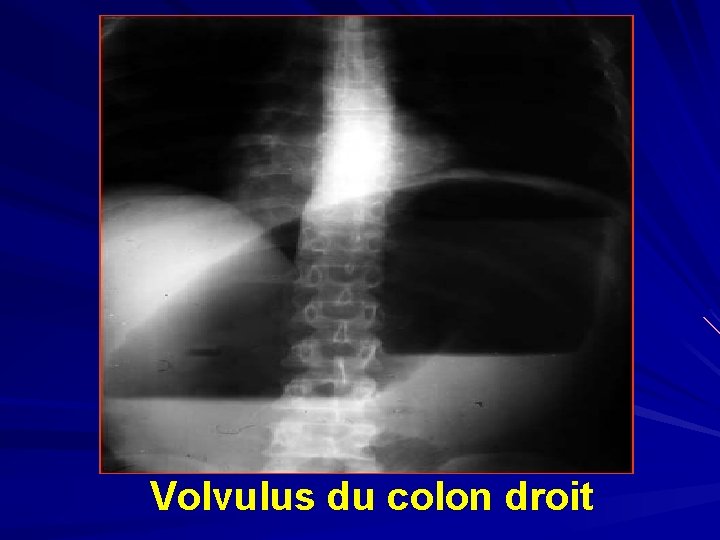 Volvulus du colon droit 