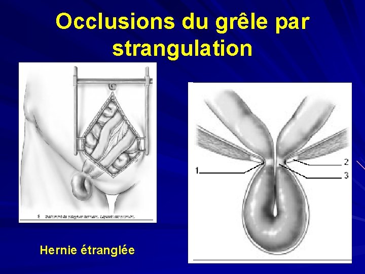 Occlusions du grêle par strangulation Hernie étranglée 