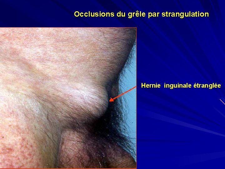 Occlusions du grêle par strangulation Hernie inguinale étranglée 