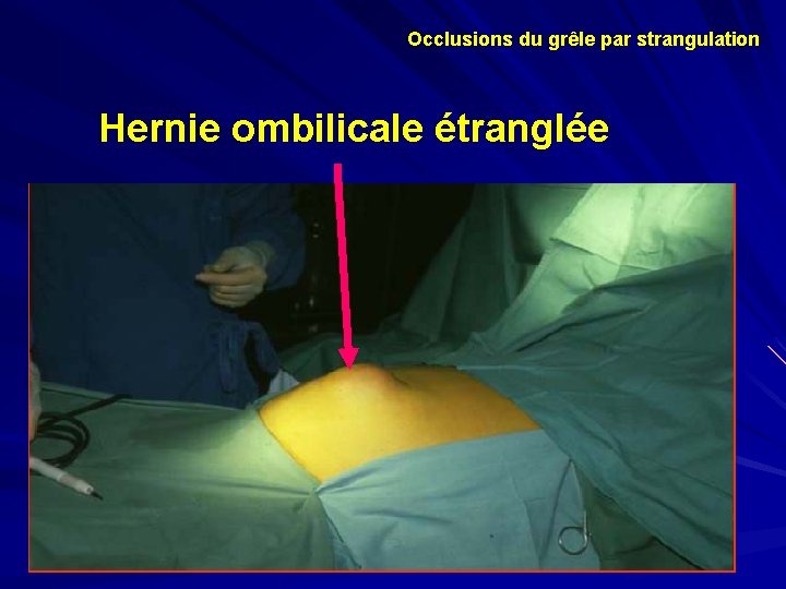 Occlusions du grêle par strangulation Hernie ombilicale étranglée 