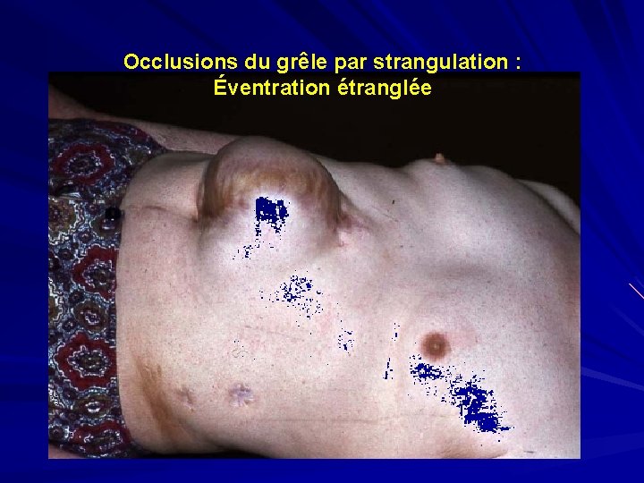 Occlusions du grêle par strangulation : Éventration étranglée 