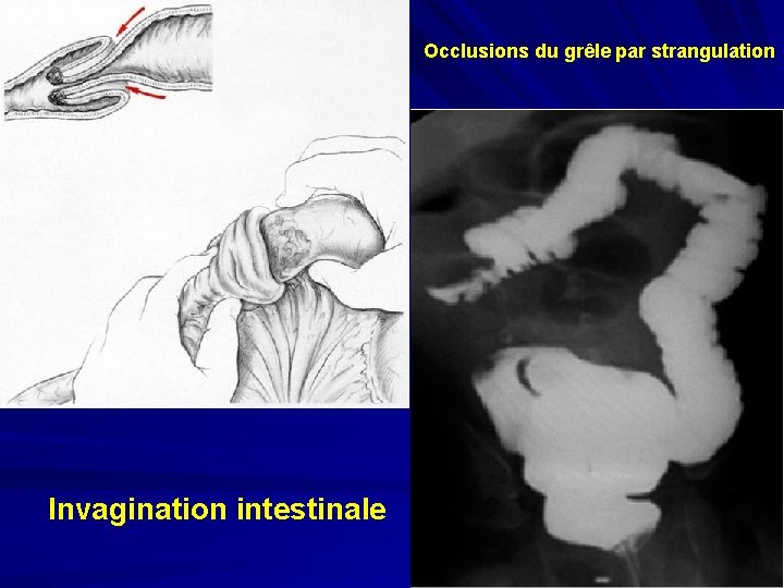 Occlusions du grêle par strangulation Invagination intestinale 
