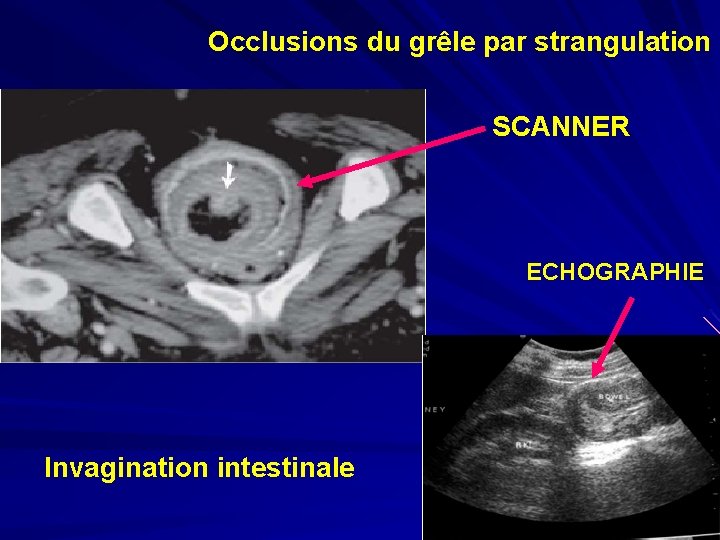 Occlusions du grêle par strangulation SCANNER ECHOGRAPHIE Invagination intestinale 