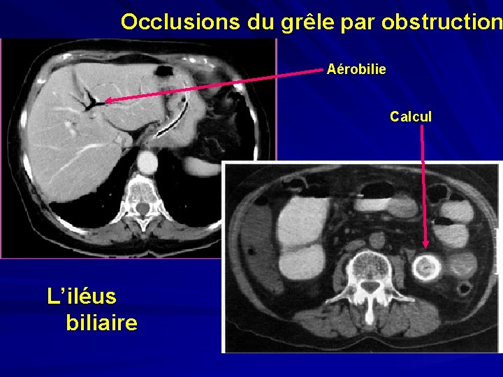 Occlusions du grêle par obstruction Aérobilie Calcul L’iléus biliaire 