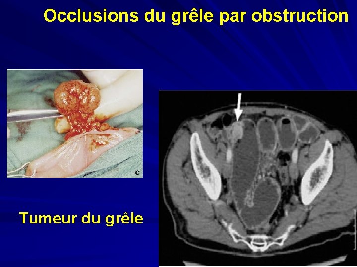 Occlusions du grêle par obstruction Tumeur du grêle 